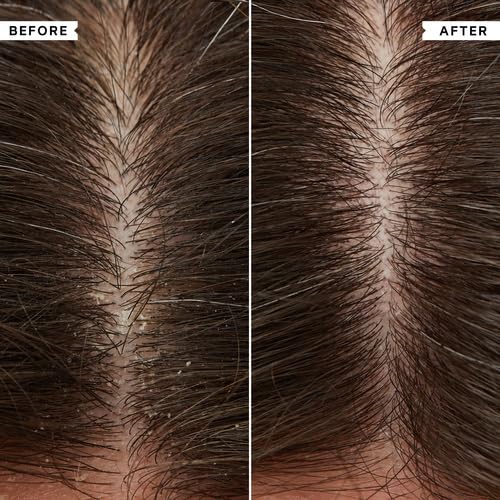 PHILIP KINGSLEY Conditioner for Flaky Scalp, 6.76 fl oz - Hydrating, Nourishing, Moisturizing, Detangles, Moisturizes Dry Hair, Suitable for Oily and Dry Scalps, Paraben Free, Vegan