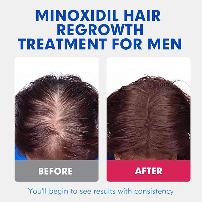 5% Minoxidil for Men Hair Regrowth Treatment, Extra Strength Topical Solution for Thinning Hair & Balding, Beard Growth Enhancer, Non-Greasy Fast-Absorbing Formula, 4-Pack (240ml) 4-Month Supply