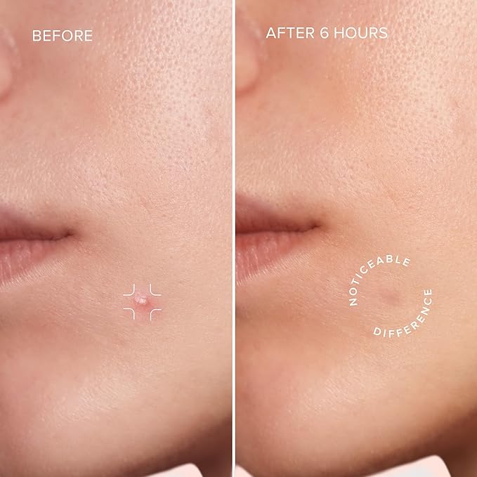 MAREE Star Pimple Patches for Face 2 PACK - Hydrocolloid Acne Patches w/Salicylic Acid, Tea Tree Oil & Centella - Cute Pimple Patches Stars - Teens Zit Patches Stickers - Parches Para Acne - 144 Dots