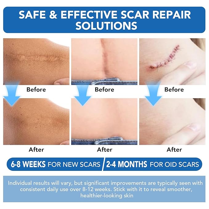 Silicone Scar Sheets, Silicone Scar Tape(1.6"x 120" Roll-3M) - Reusable, Soft & Medical Grade Adhesive Tape for Old & New Scars, C-Section, Surgery, Keloid & Acne Scars