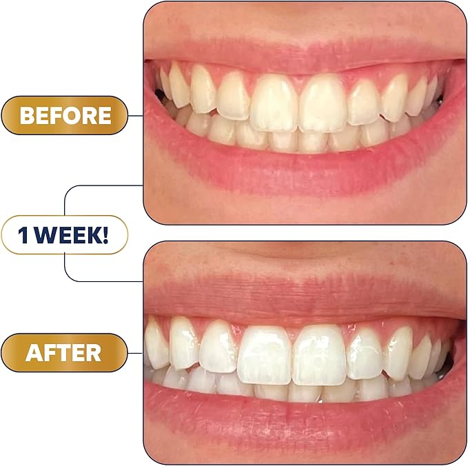 Lumineux Longevity Whitening Kit Bundle - Contains 6X Toothpastes, 6X Mouthwashes, 2X Strips and 2X Whitening Pens - Enamel Safe and Clinically Proven to Whiten Without The Sensitivity