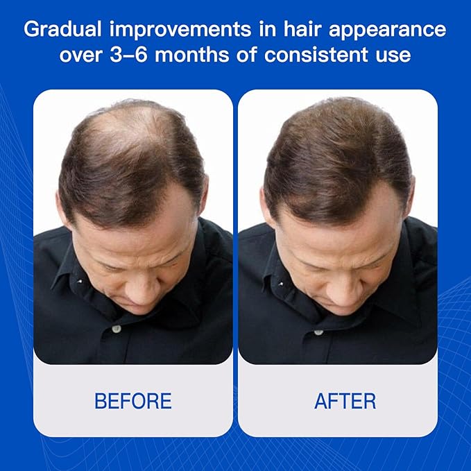 Rosemary Hair Growth Serum with Redensyl and Anagain – Roll On 25 ml, Thicker & Stronger Hair, Prevents Hair Fall & Stimulates Hair Follicles, Fights Hair Thinning & Hair Loss for All Hair Types