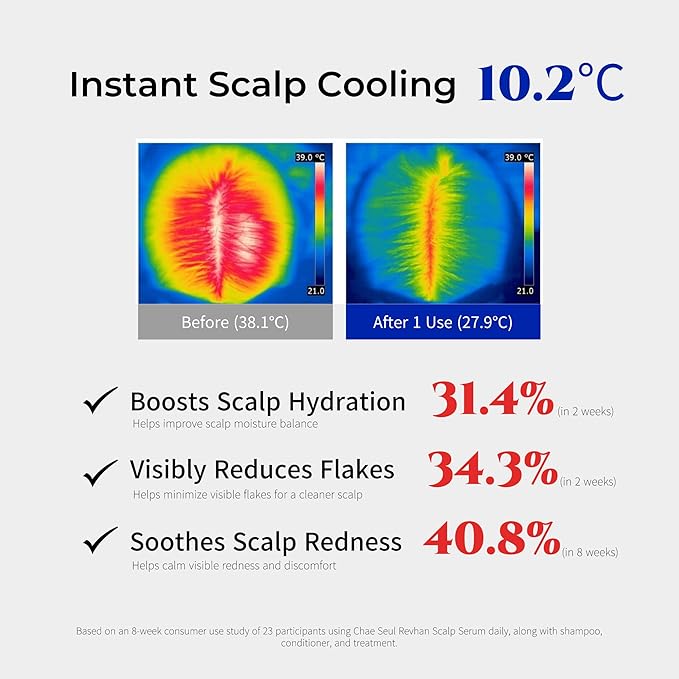 Revhan Scalp Serum for Hair Loss & Thinning – Hair Growth Serum for Men & Women w/Salicylic Acid & Centella Asiatica – Soothes Itchy, Irritated Scalp with Roll-On