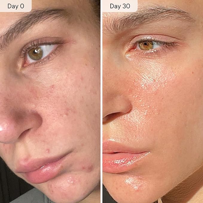 Qure Micro Infusion System for Face & Neck - Facial Moisturizing Essence, Even-looking tone, Serum for All Skin Types, Refreshed and Luminous Skin - 1-Month Supply