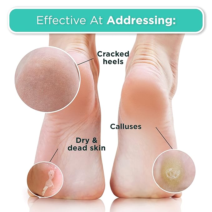 DERMORA Foot Peel Mask | Skin Exfoliating Foot Masks | Dry, Cracked Feet, Callus, Dead Skin Remover | Baby Soft Feet | Original Scent | Pack of 4 | Regular