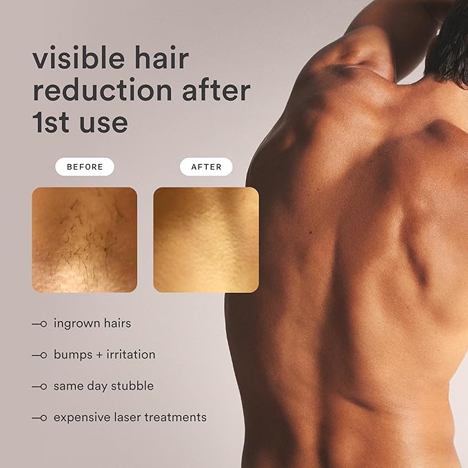 Nood™ Flasher Pro — IPL Laser Hair Removal Device & Anti-Aging Red Light Therapy for Women & Men — Pain-free & Permanent, Visible Results After First Use & Works Everywhere Hair Grows — Matte Black
