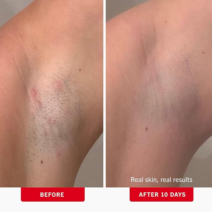 First Aid Beauty - Ingrown Hair Pads with BHA + AHA - Aftershave Treatment Pads Help Men & Women Prevent Razor Bumps, Exfoliate Underarms & Bikini Area, Compostable for Daily Use - 3ct, 84 Pads Total