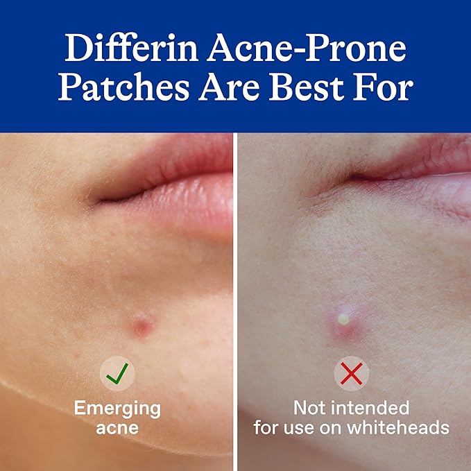 Differin Acne Patches, Pimple Patches for Acne Prone Skin, Formulated with Salicylic Acid and Centella, Fast Triple Action Power Patch for Day & Night, Dermatologist Tested, 36 Count