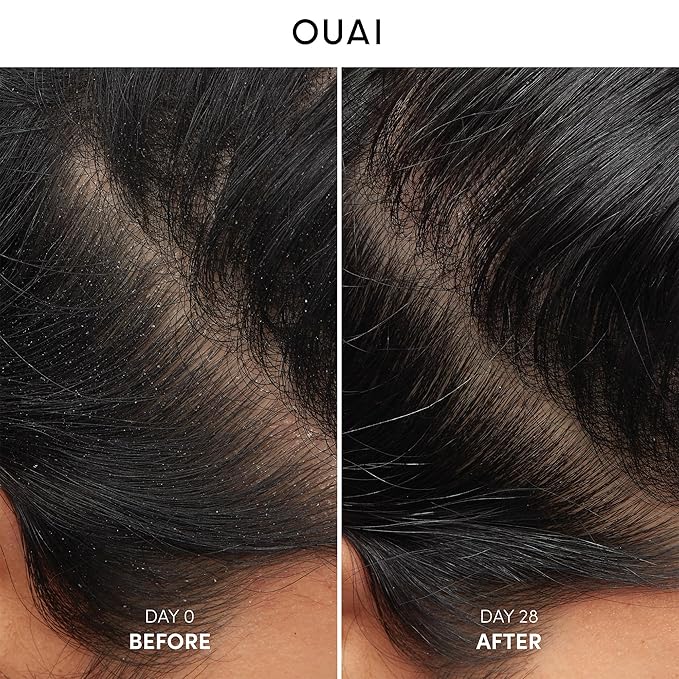 OUAI Anti Dandruff Shampoo - Soothing Salicylic Acid Shampoo for Flaky, Dry and Itchy Scalp - Reduces Itching, Redness and Irritation - Sulfate Free Scalp Care (10 Fl Oz)